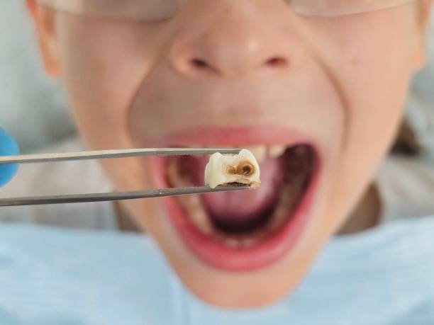 Best Emergency Dental Extractions in De Smet, SD